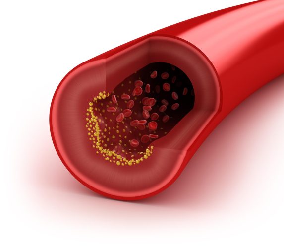 Cholesterol plaque in artery, concept isolated on white