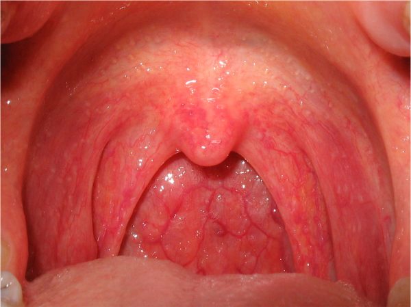 Pharyngitis