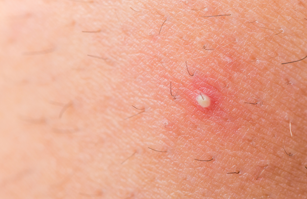 Red Bumps on Legs, Thighs, Like Pimples, Lumps, Small ...