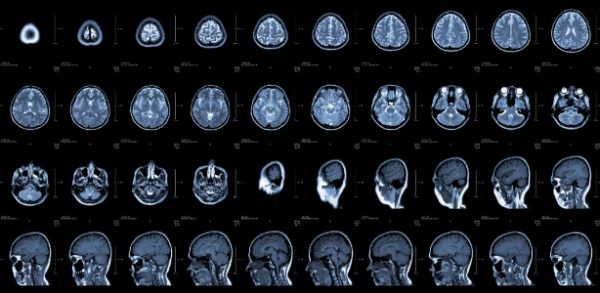 ressonancia-magnetica-do-cerebro-1361993061023_615x300
