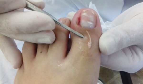 unha-encravada-apaixonada-por-pijama3