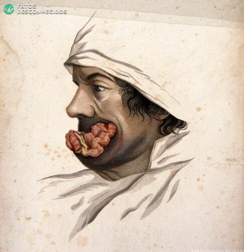 V0009620 Head of a man with a skin disease on his