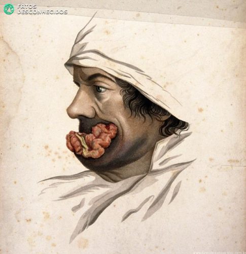 V0009620 Head of a man with a skin disease on his