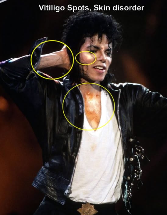 Vitiligo em Michael Jackson - Reprodução