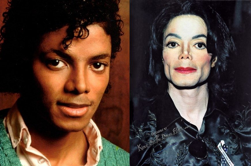 O que é o vitiligo? Como Michael Jackson ficou branco? Fatos Desconhecidos