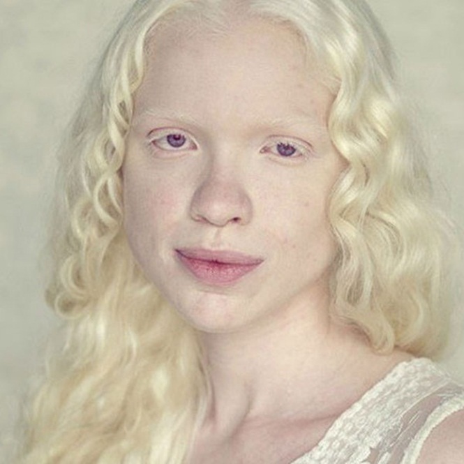 Albino Xxx 87