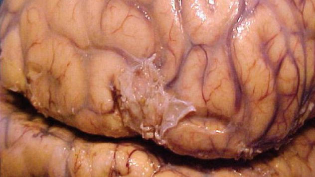 5 doenças horripilantes que você pode contrair em qualquer refeição