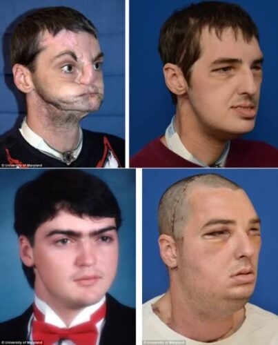a98383_face-transplant_1-most-extensive