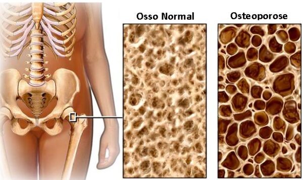 cientistas_descobrem_cura_para_osteoporose