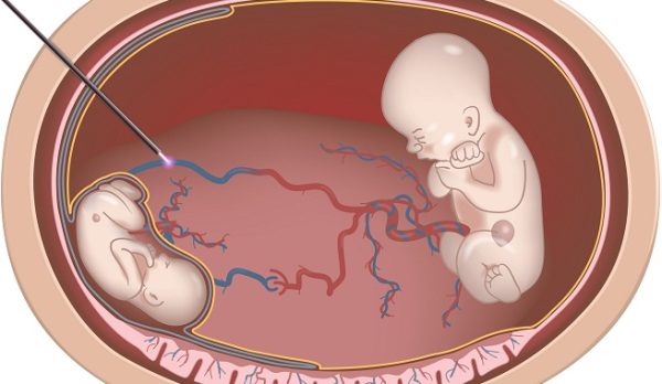 Que-es-el-desprendimiento-de-la-placenta