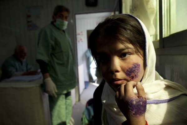 KABUL, AFGHANISTAN - OCTOBER 26 Shafiqa,14, waits for treatment at a free specialized clinic for leishmaniasis supported by World Health Organization (WHO) October 26, 2010 in Kabul, Afghanistan. Leishmaniasis is a disease caused by a parasite transmitted by a tiny sandfly that can lead to severe scarring, often on the face. Leishmaniasis plagues Afghanistan's poor, who often sleep on the floor, and the disease isn't a priority for the government and its aid donors who are grappling with infant mortality, tuberculosis, malaria and trauma. The most common form of the disease is not fatal, but causes untold misery and scarring on faces, stigmatizing children who are excluded at school and making it hard for girls to find husbands. According to WHO, there were an estimated 65,000 reported cases from the 2009. (Photo by Paula Bronstein/Getty Images)