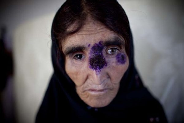 KABUL, AFGHANISTAN - MAY 15: An Afghan recieves treatment for a tropical skin disease at a clinic on May 15, 2010 south of Kabul, Afghanistan. The Afghan capital, Kabul, has one of the highest concentrations of the disfiguring skin disease, Cutaneous leishmaniasis, which is a parasitic disease transmitted by the phlebotomine sand fly. The World Health Organization estimated the number of cases in Kabul jumped from 17,000 in early 2000 to around 65,000 in 2009; the disease is non-lifethreatening and treatable with medication. (Photo by Majid Saeedi/Getty Images)