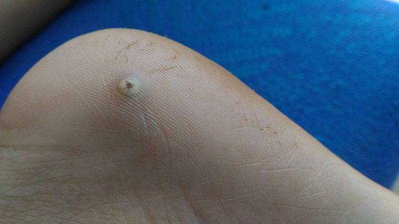 Se o bicho de pé não for tratado ele se transforma em outra coisa