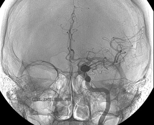 Embolization for treating aneurysm in the brain
