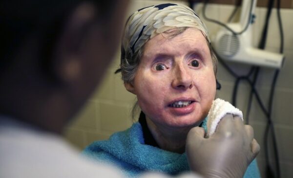 In this Friday, Feb. 20, 2015 photograph, Charla Nash smiles as her care worker washes her face at her apartment in Boston.  The Department of Defense is following Nash's progress, after funding her transplant surgery in 2011. Nash lost her face, eyes and hands after being mauled by a chimpanzee in 2009. (AP Photo/Charles Krupa)