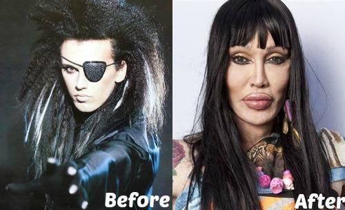 Pete-Burns-Plastic-Surgery