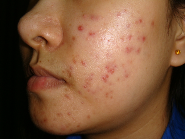 acne-no-rosto