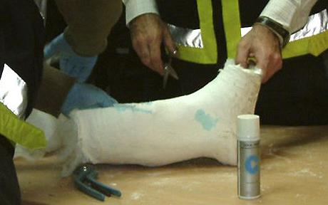 In this photo released by Spanish Police, police cut a cast made of cocaine that was worn by a 66-year-old Chilean man who tried to smuggle the drugs into Barcelona airport on Wednesday, March 4, 2009. (AP Photo/Spanish Police, HO) ** EDITORIAL USE ONLY **