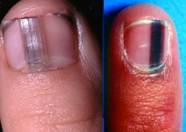 TPNN-black-nail-stripe