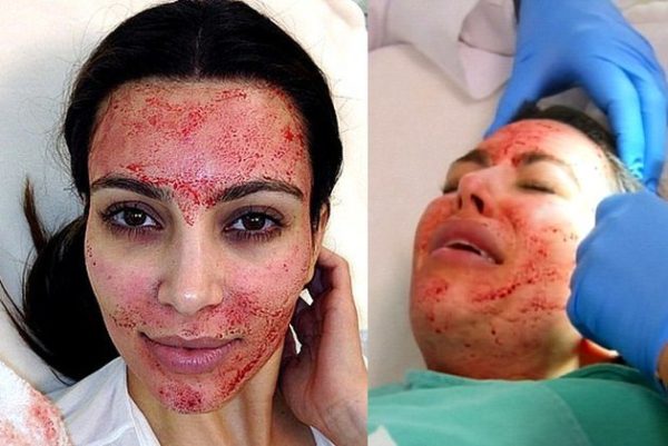 gallery_big_blood_facial_kim_kardashian