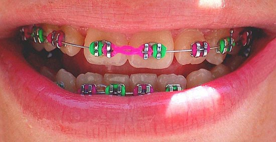 aparelho-dental-elastico-colorido-005