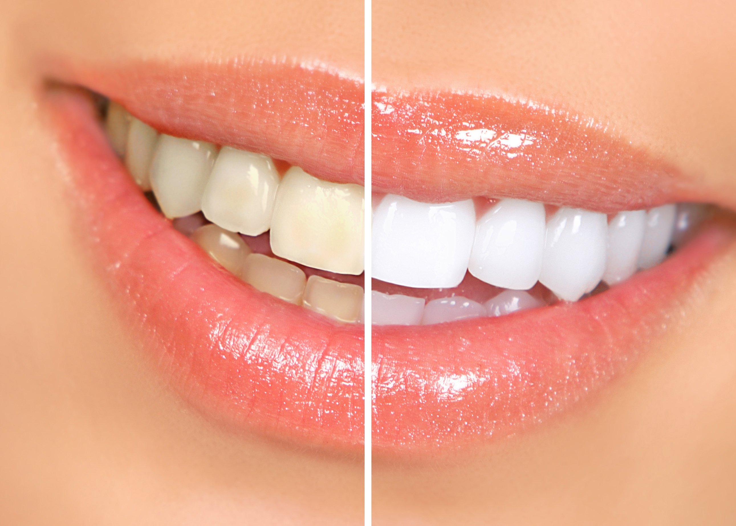 Aprenda a deixar seus dentes mais brancos em apenas 2 minutos sem sair da sua casa