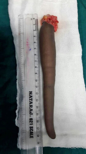 MAHARASHTRA, INDIA - OCTOBER, 03, 2016 : Picture of a 18 cm long tail which was removed from the back of 18-year-old boy after its abnormal growth turned painful for him at Government Super Specialty Hospital (SSH) in Maharashtra, India. A team of neurosurgeons have successfully removed the longest recorded tail (18-cm long) from from the back of a 18-year-old boy. As per the doctors, the tail had grown from the posterior end of the body on the back of 18-year-old boy.