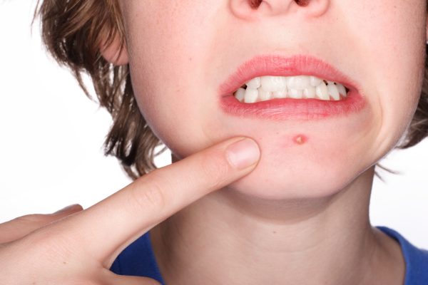 An adolescent boy pointing at a  pimple on his chin and grimacing