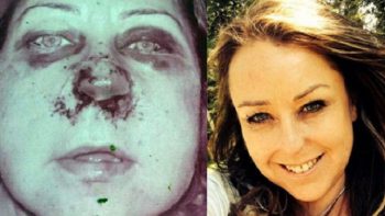 10 imagens brutais que mostram o antes e depois de pessoas que pararam de usar drogas