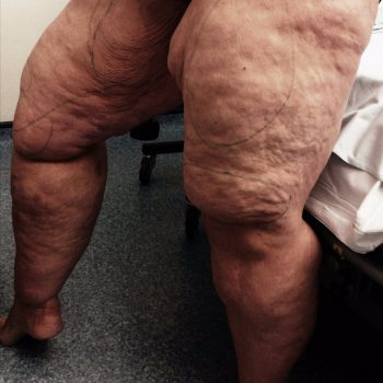 Essa mulher tirou 12 litros de gordura das pernas e ficou irreconhecível