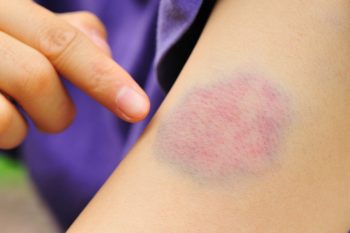 7 coisas que podem significar aqueles roxos que aparecem do nada na sua pele