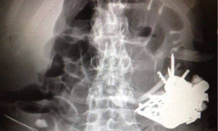 Homem dá entrada em hospital com suspeita de envenenamento e encontra algo muito mais assustador em seu estômago