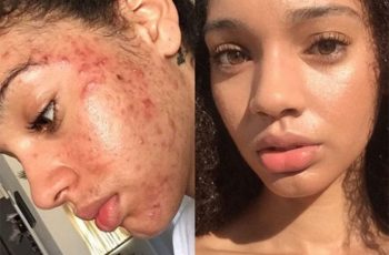 Essa mulher curou a acne em apenas um mês, descubra como ela fez isso