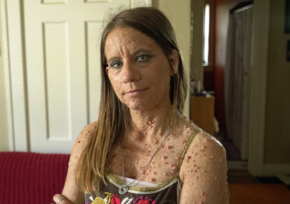 Conheça a mulher que teve mais de 6000 tumores espalhados pelo corpo