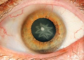 7 coisas medonhas que podem acontecer com seus olhos