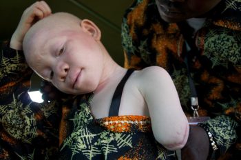 Albinos estão sendo caçados em Malauí por conta de seus ossos