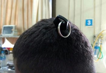 Homem tinha chave alojada no cérebro e mesmo assim conseguiu sobreviver