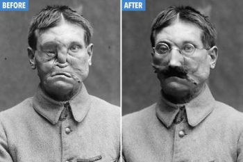 Fotos chocantes de 100 anos mostram soldados deformados recebendo máscaras plásticas