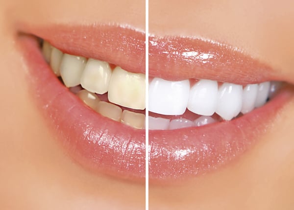 7 tratamentos naturais para retirar manchas dos dentes