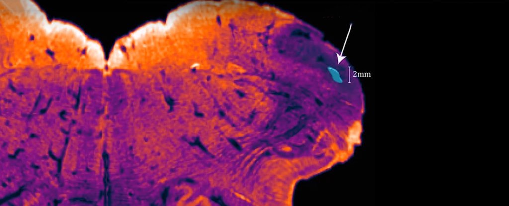 Cientistas descobrem nova parte do cérebro totalmente por acidente