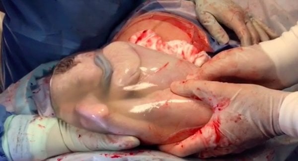 Vídeo incrível mostra bebê que nasceu dentro do saco amniótico