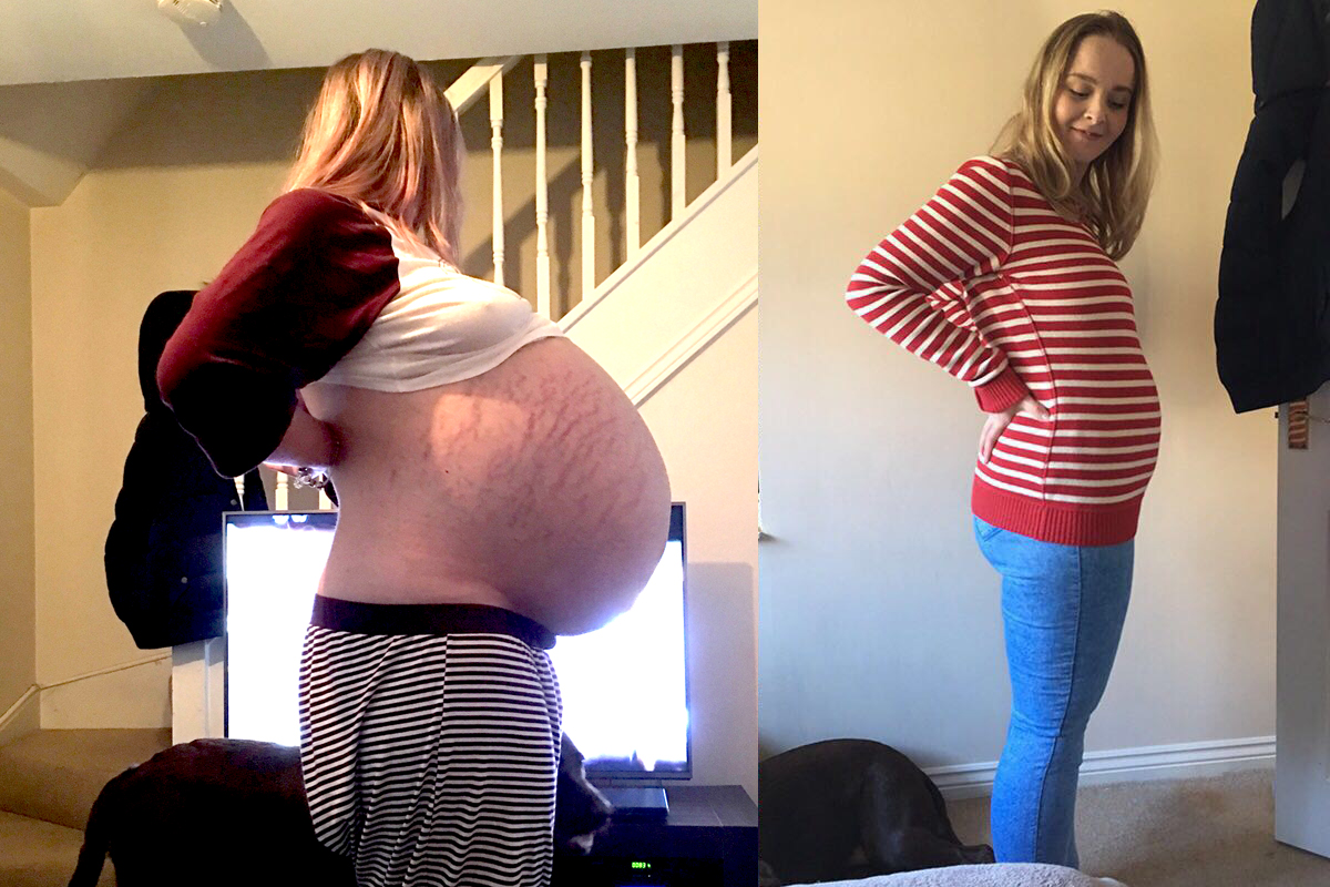 Ela suspeitou que era uma gravidez até que sua barriga cresceu durante 3 anos