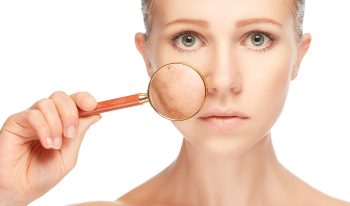 Entenda porque algumas pessoas sofrem mais com acnes do que outras