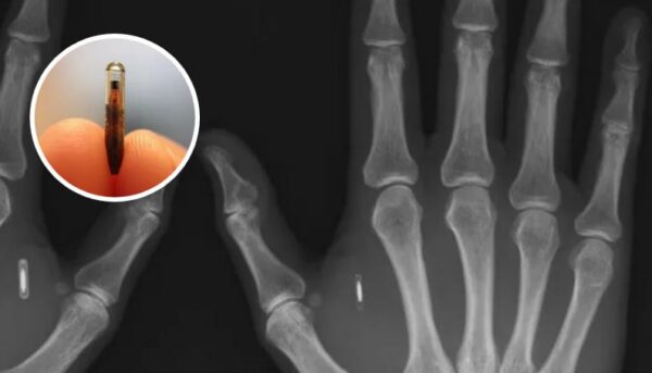 CHIP IMPLANTADO NO CORPO JÁ É REALIDADE NO BRASIL - WINEW CHIP IMPLANTADO NO CORPO JÁ É REALIDADE NO BRASIL - WINEW