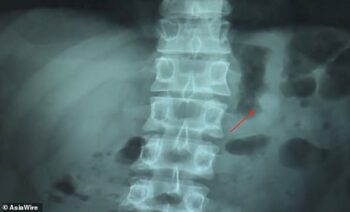 Jovem engole fones de ouvido e afirma que ainda estão funcionando