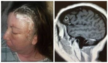 Mulher viveu quase 1 ano com uma tênia em seu cérebro acreditando que era um tumor