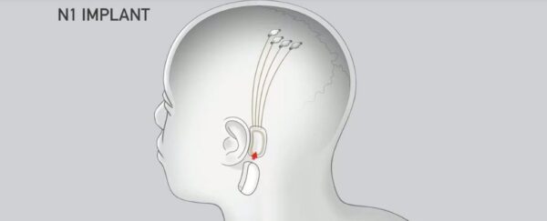 implante Elon Musk tem ideia de implantes mentais assustadores implante