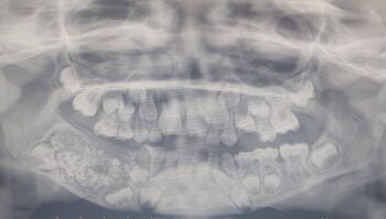 Médicos encontram 526 dentes na boca de menino depois de queixas de dor no maxilar