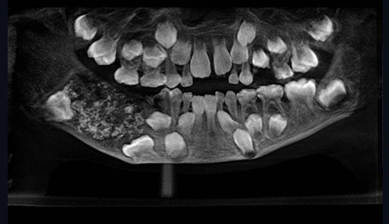 dentes Médicos encontram 526 dentes na boca de menino dentes