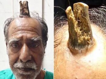 Homem com chifre de 10 cm recebe ajuda médica na Índia